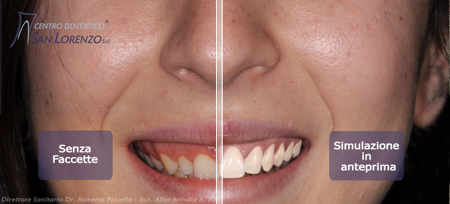 Faccette dentali: prima e dopo con la progettazione digitale
