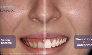 Faccette dentali: prima e dopo con la progettazione digitale