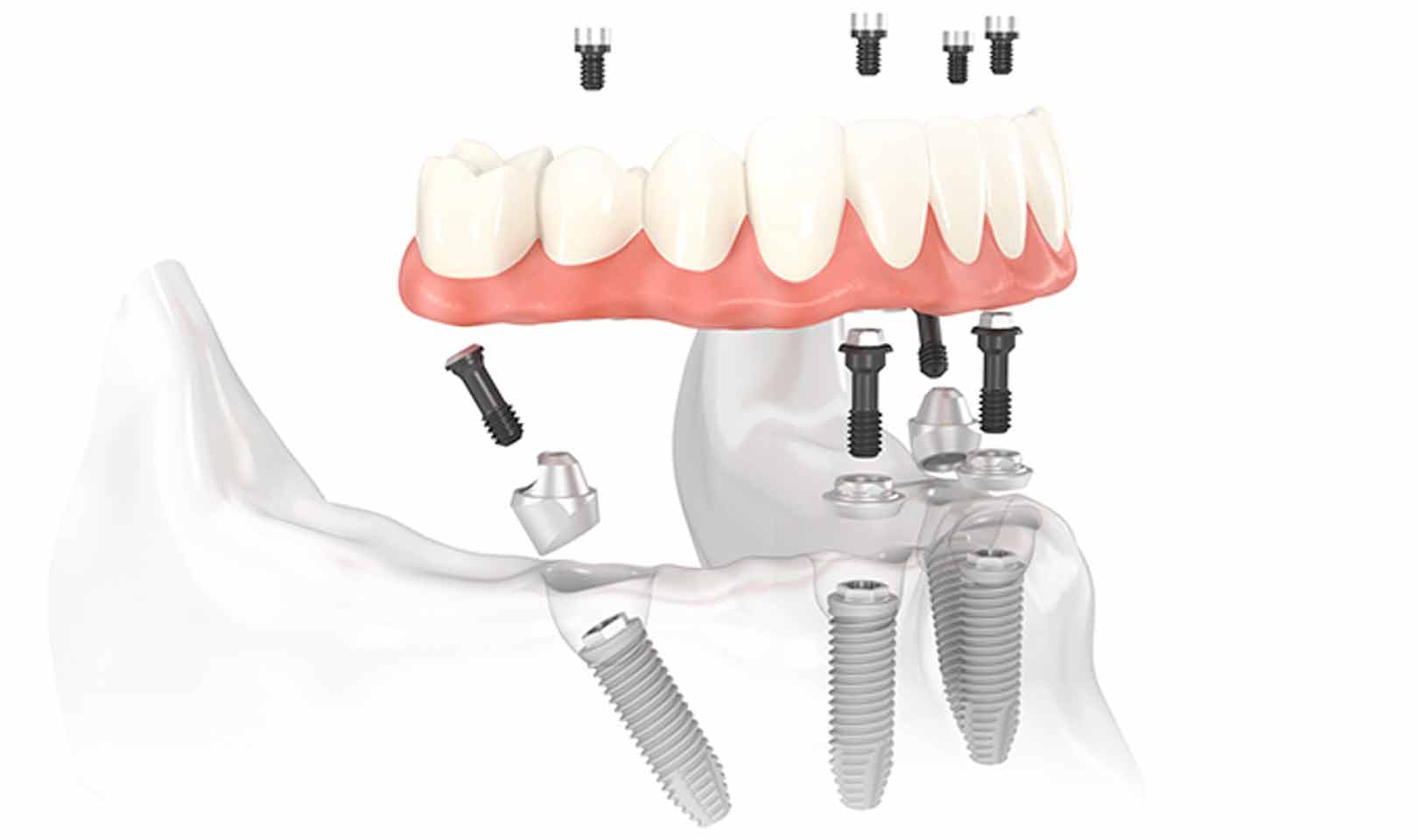 Impianti dentali Brindisi All on four