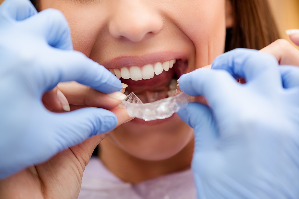 Mascherina ortodontica trasparente Invisalign ortodonzia invisibile Brindisi Centro dentistico San Lorenzo Srl