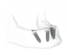 Denti fissi con la tecnica All on four Brindisi studio dentistico