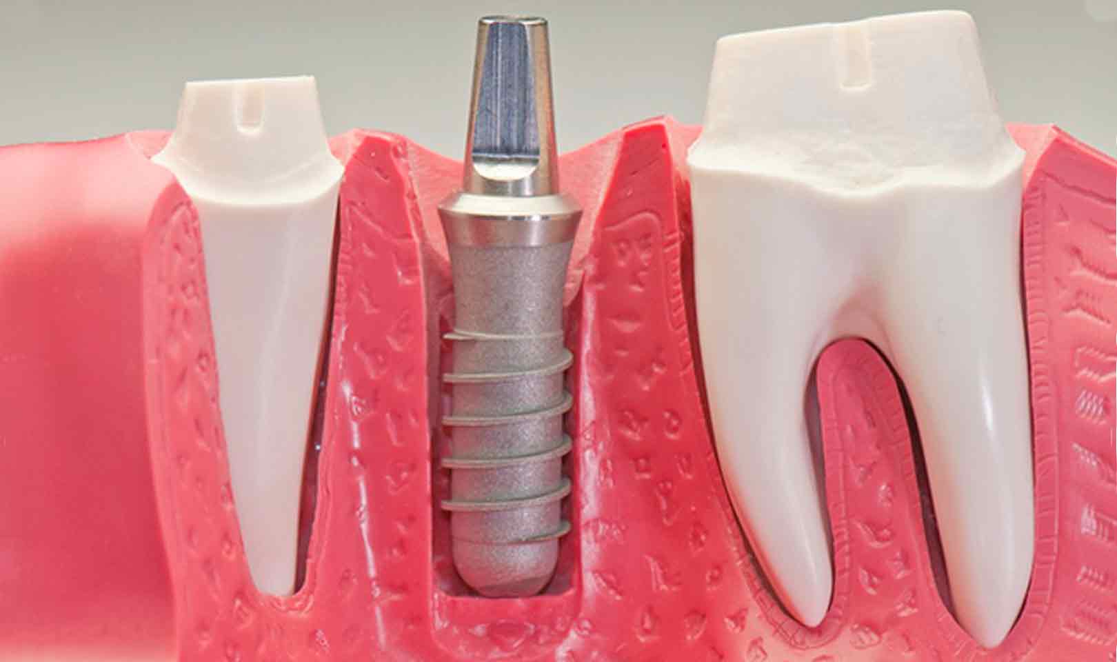 Impianti dentali Brindisi