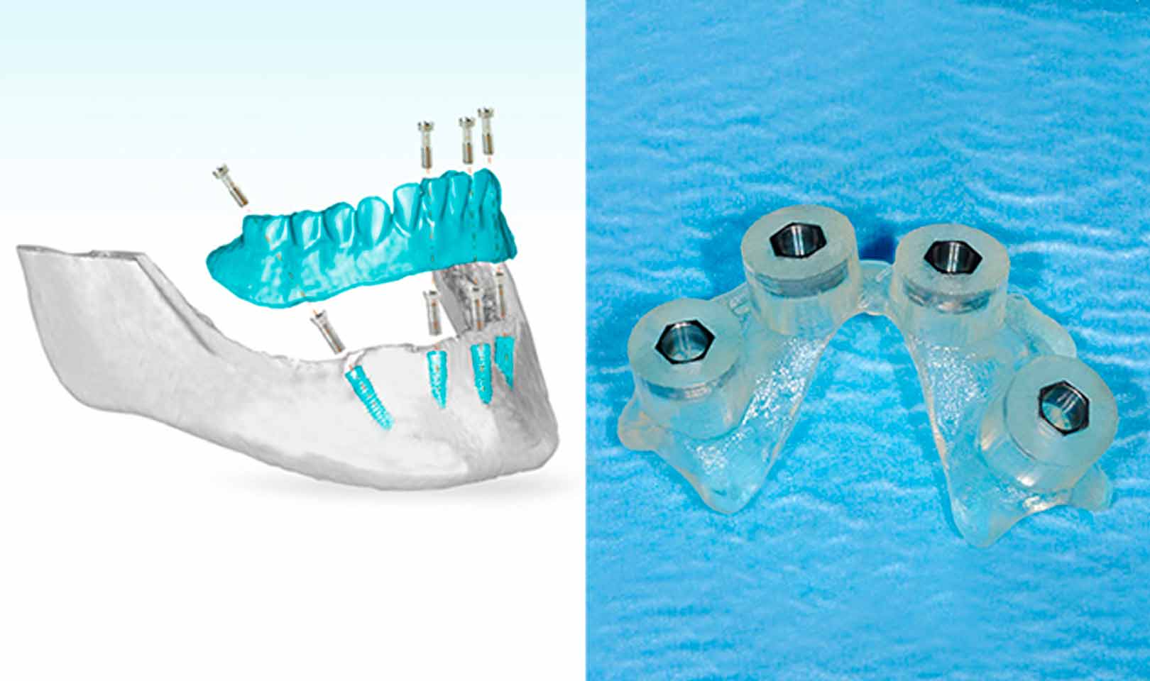 implantologia computer guidata Bindisi Dentista