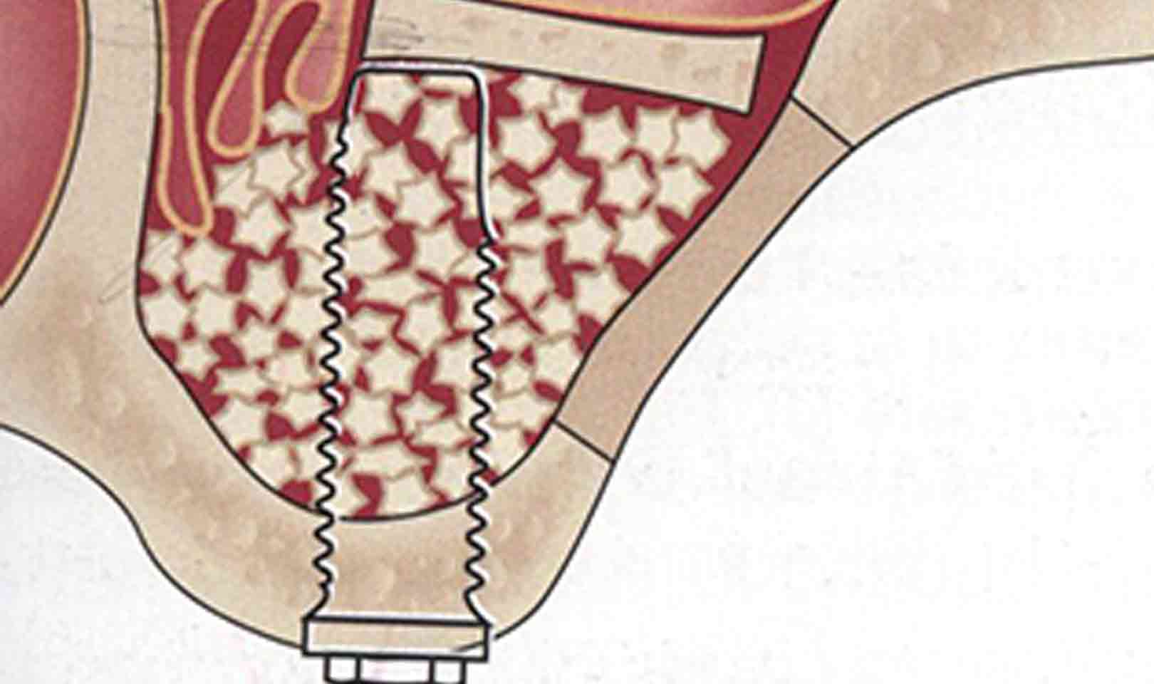 Rialzo del seno mascellare per impianto dentale