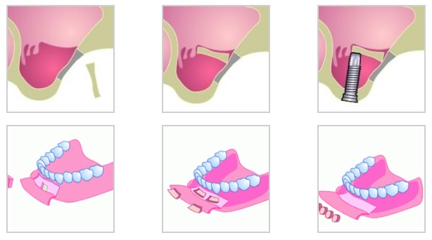 Sinuslift Brindisi Centro Dentistico San Lorenzo