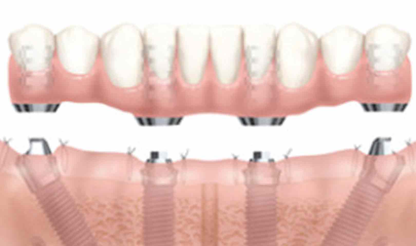 Toronto Bridge Brindisi Centro Dentistico San Lorenzo