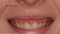 Faccette dentali prima e dopo progettazione digitale