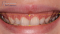 Faccette dentali progettazione digitale