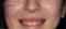 Feccette dentali prima e dopo situazione di partenza