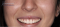 Opzione faccette 1 Faccette dentali progettazione digitale
